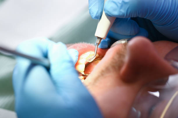 Best Broken or Chipped Tooth Repair in Lake Camelot, IL